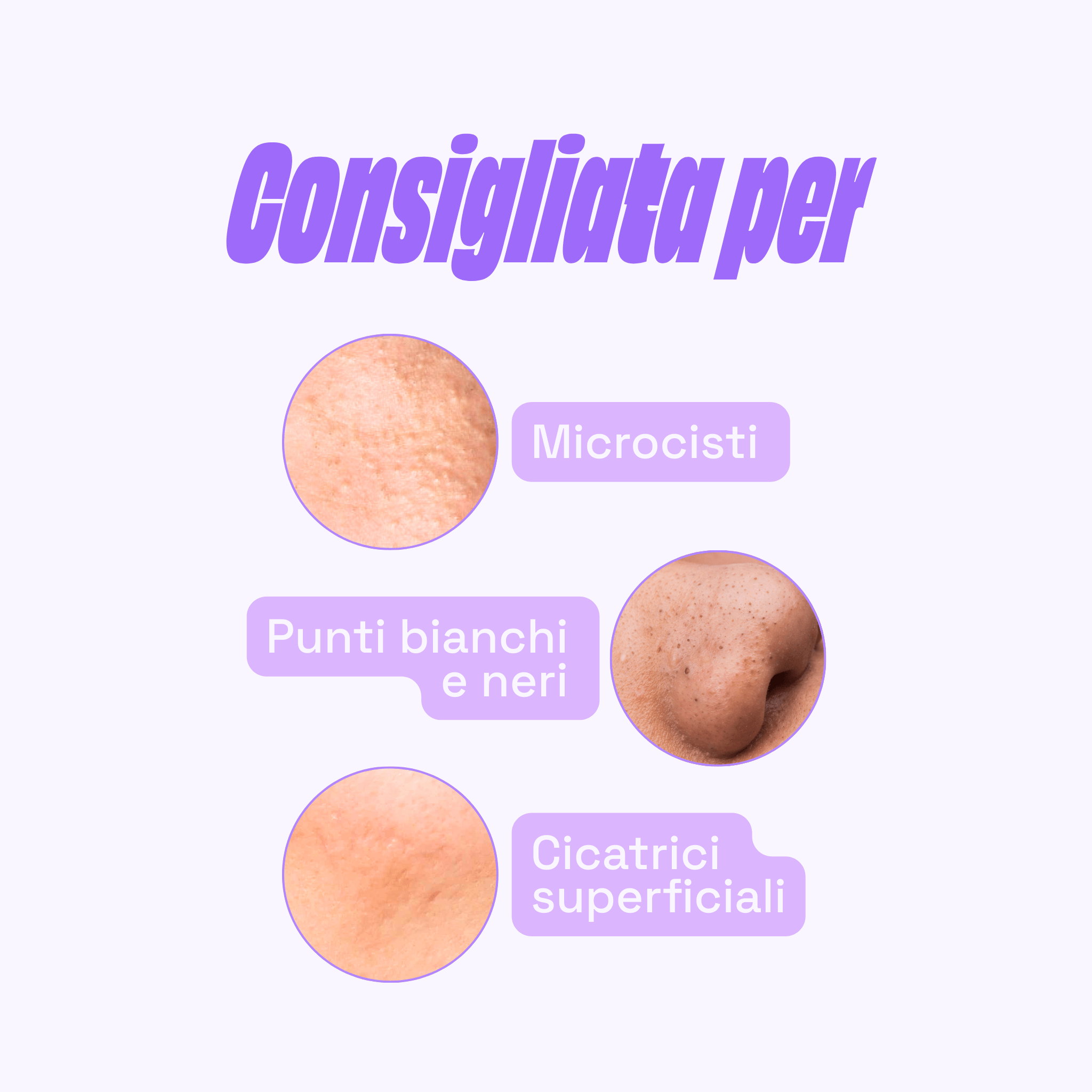 Consigliata per Microcisti, Punti bianchi e neri, Cicatrici superficiali - Retinolo & Vitamina E - Night Cream - 1 mese gratis